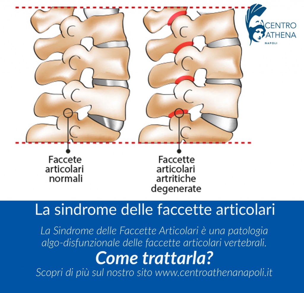 faccette